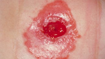 防止造口渗漏-造口周围皮肤刺激